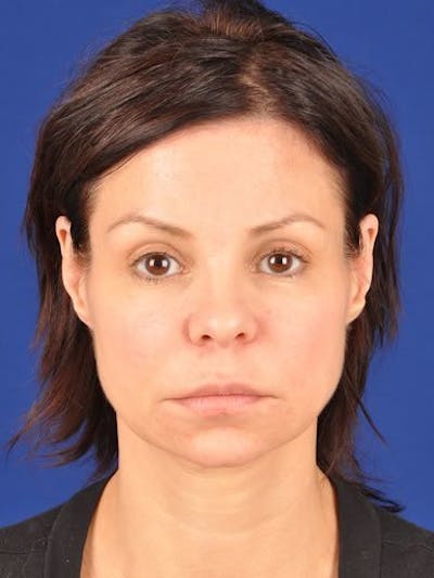Fat Transfer Face Before & After Gallery - Patient 17363761 - Image 1