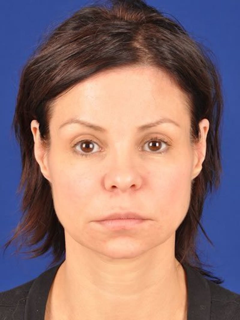 Fat Transfer Face Before & After Gallery - Patient 17363761 - Image 1