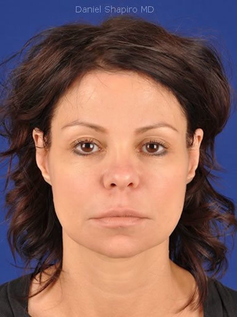 Fat Transfer Face Before & After Gallery - Patient 17363761 - Image 2