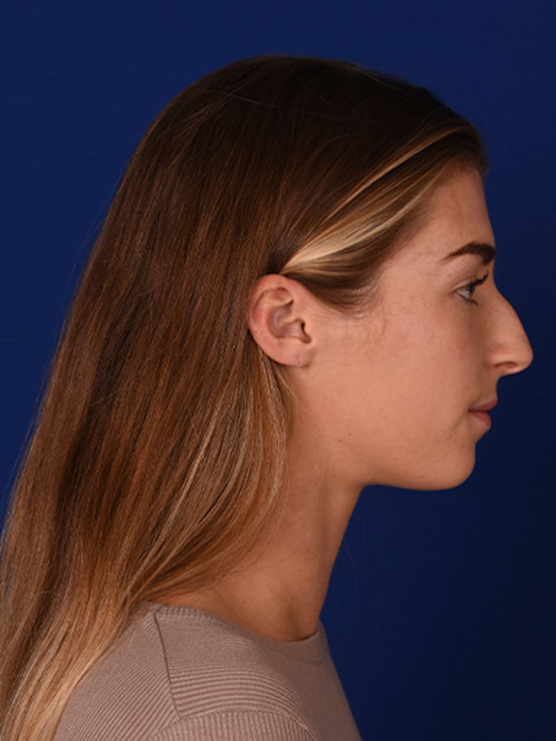 Female Rhinoplasty Before & After Gallery - Patient 17363760 - Image 5