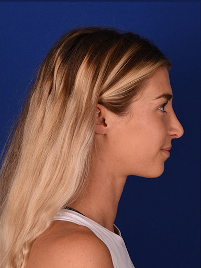 Female Rhinoplasty Before & After Gallery - Patient 17363760 - Image 6