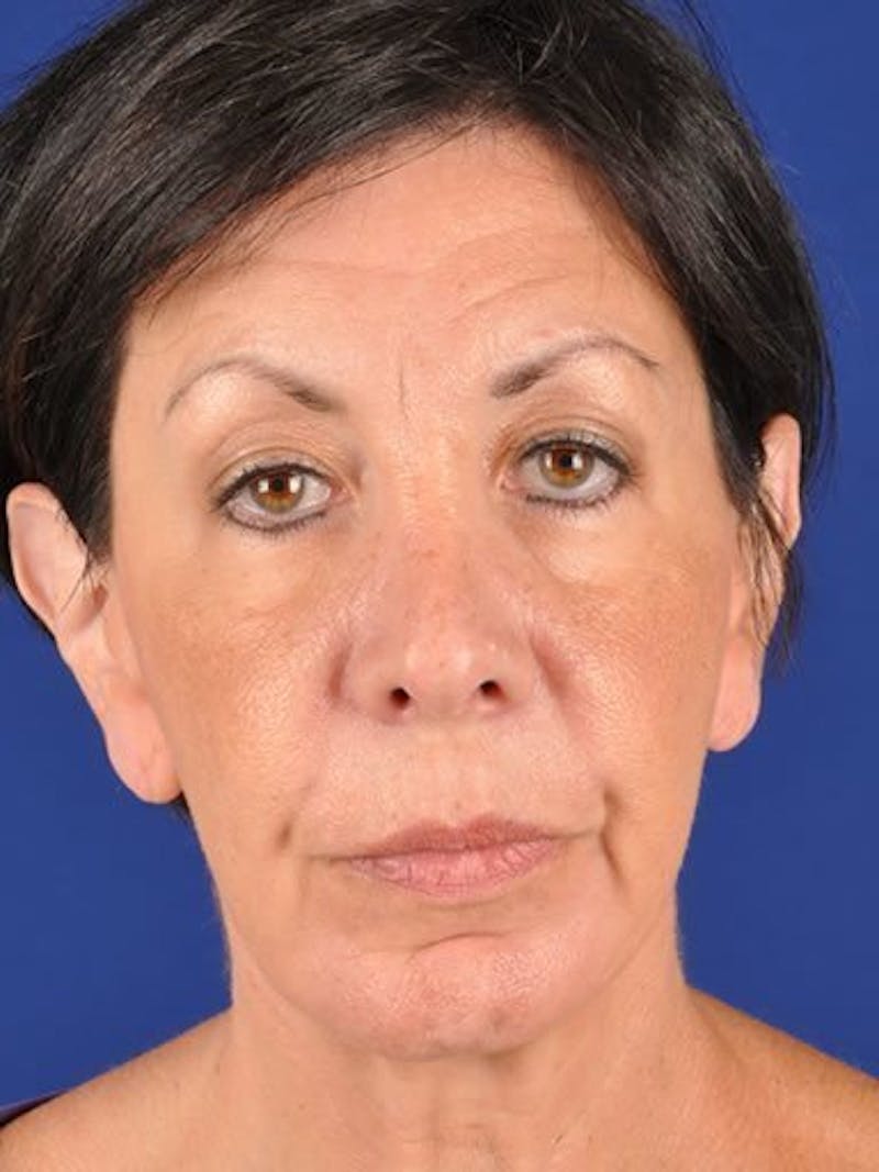Fat Transfer Face Before & After Gallery - Patient 17363762 - Image 1