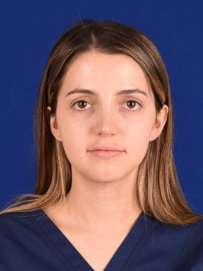 Female Rhinoplasty Before & After Gallery - Patient 17363763 - Image 2