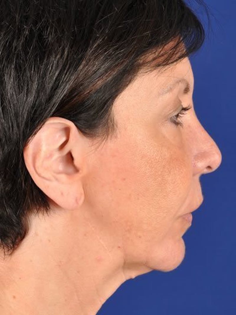 Fat Transfer Face Before & After Gallery - Patient 17363762 - Image 3