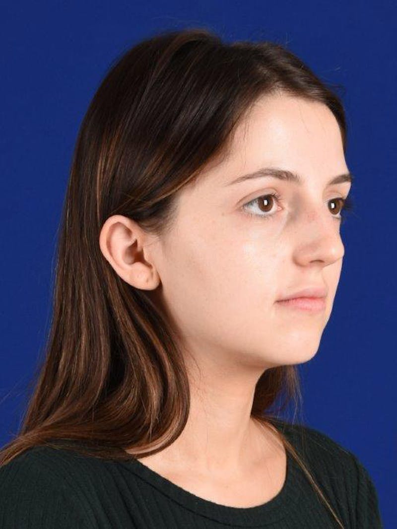 Female Rhinoplasty Before & After Gallery - Patient 17363763 - Image 3