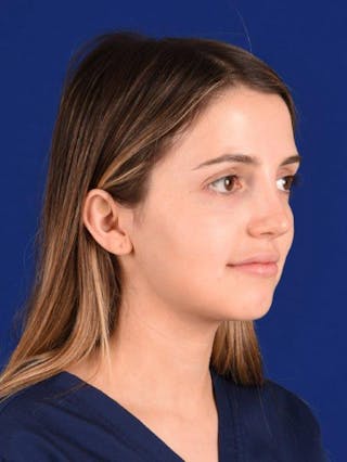 Female Rhinoplasty Before & After Gallery - Patient 17363763 - Image 4