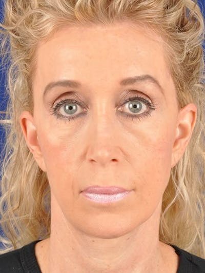 Fat Transfer Face Before & After Gallery - Patient 17363764 - Image 1