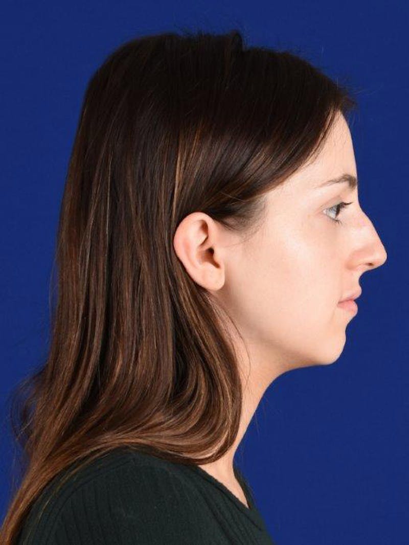 Female Rhinoplasty Before & After Gallery - Patient 17363763 - Image 5