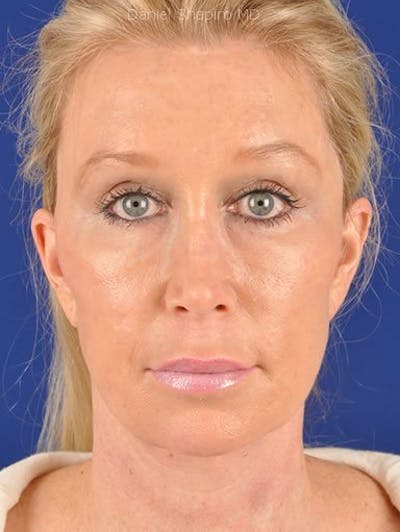 Fat Transfer Face Before & After Gallery - Patient 17363764 - Image 2