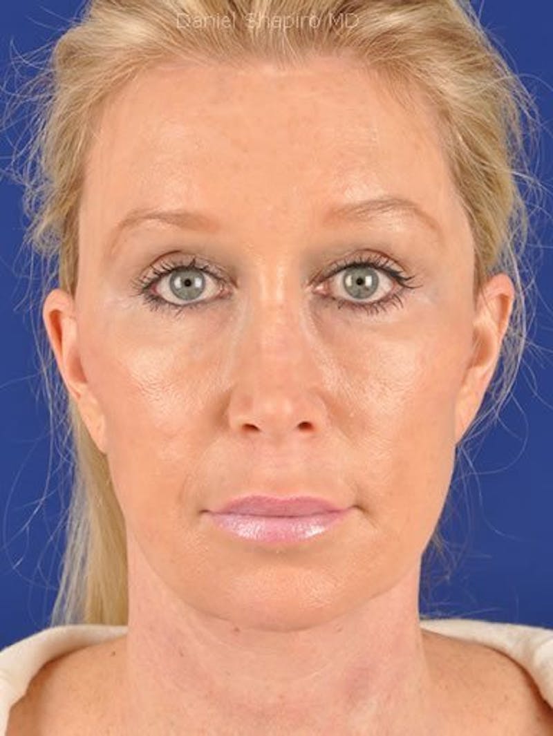 Fat Transfer Face Before & After Gallery - Patient 17363764 - Image 2