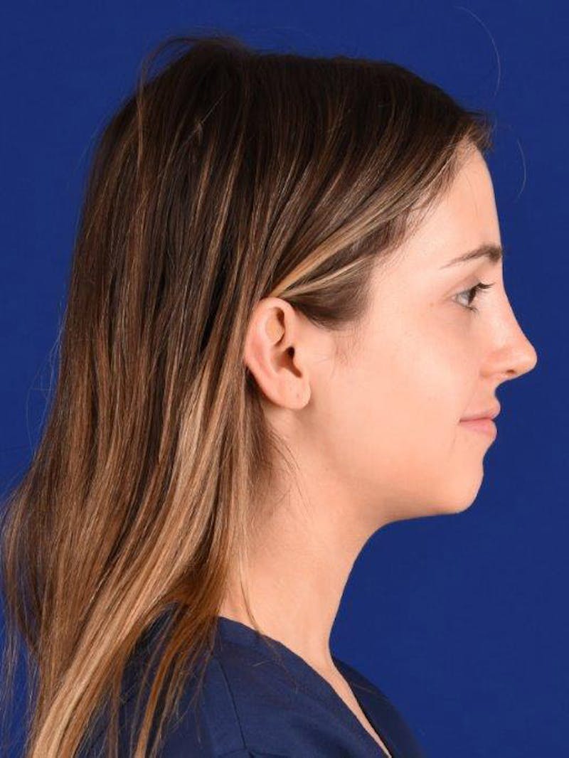 Female Rhinoplasty Before & After Gallery - Patient 17363763 - Image 6
