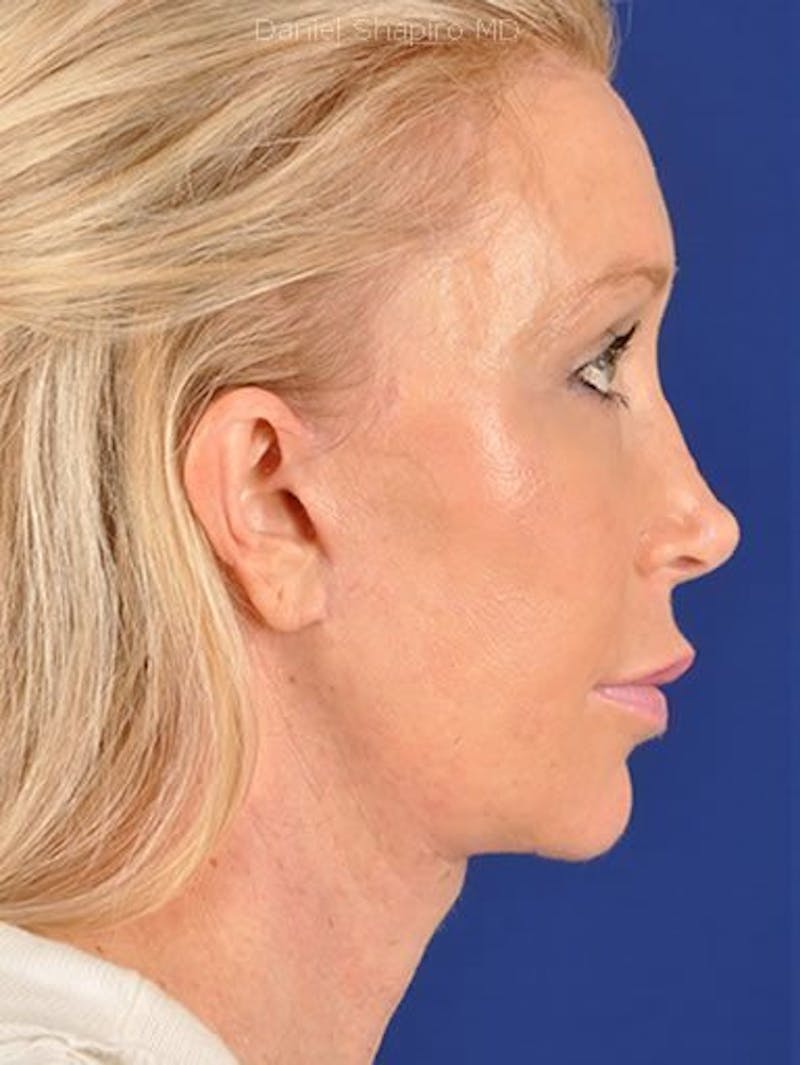 Fat Transfer Face Before & After Gallery - Patient 17363764 - Image 4