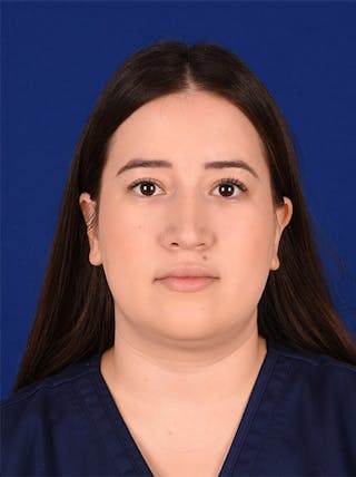 Female Rhinoplasty Before & After Gallery - Patient 17363766 - Image 2