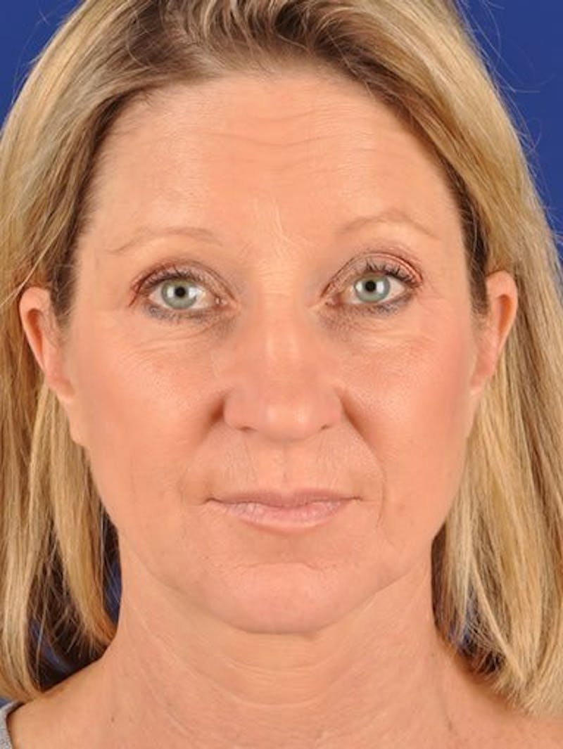 Fat Transfer Face Before & After Gallery - Patient 17363765 - Image 1