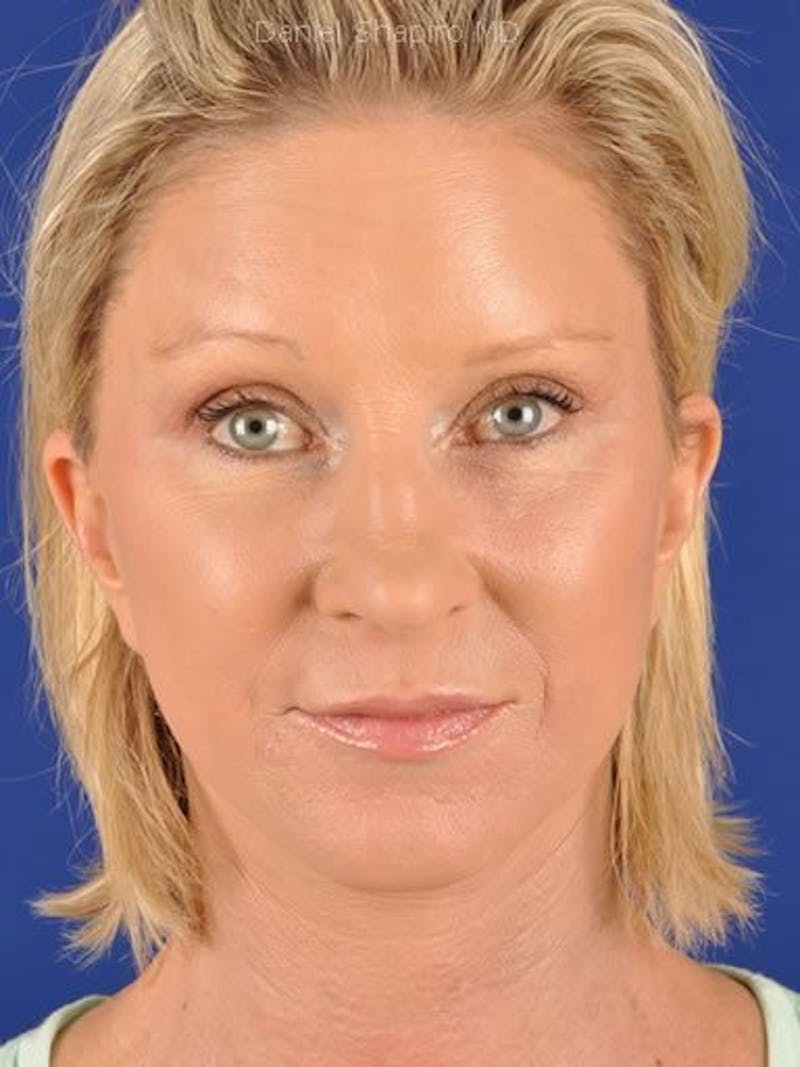 Fat Transfer Face Before & After Gallery - Patient 17363765 - Image 2