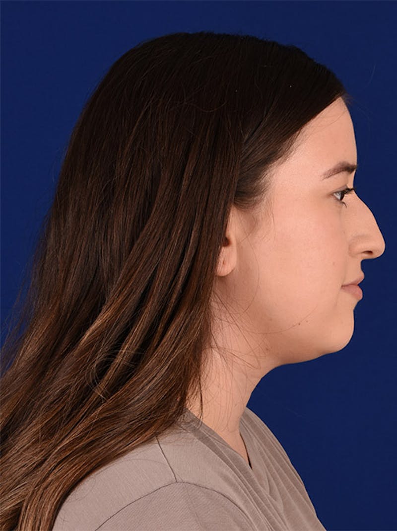 Female Rhinoplasty Before & After Gallery - Patient 17363766 - Image 5