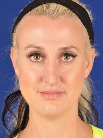 Fat Transfer Face Before & After Gallery - Patient 17363767 - Image 1