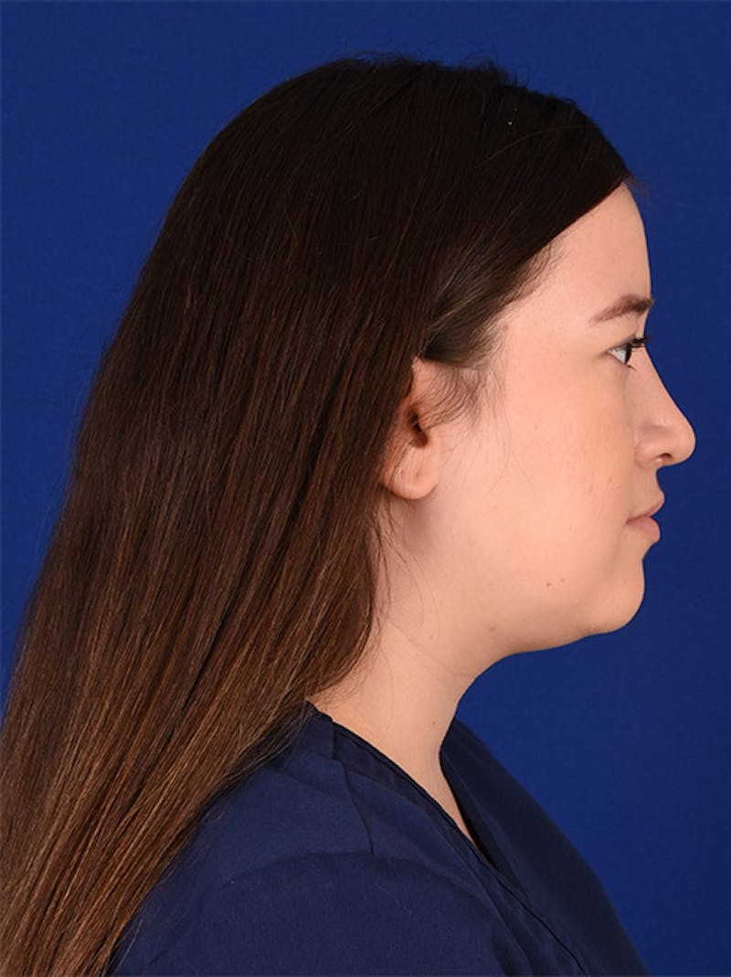 Female Rhinoplasty Before & After Gallery - Patient 17363766 - Image 6
