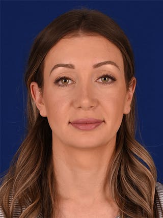 Female Rhinoplasty Before & After Gallery - Patient 17363769 - Image 2