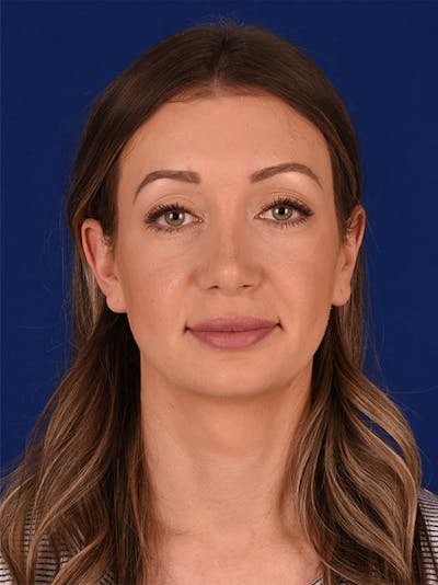 Female Rhinoplasty Before & After Gallery - Patient 17363769 - Image 2