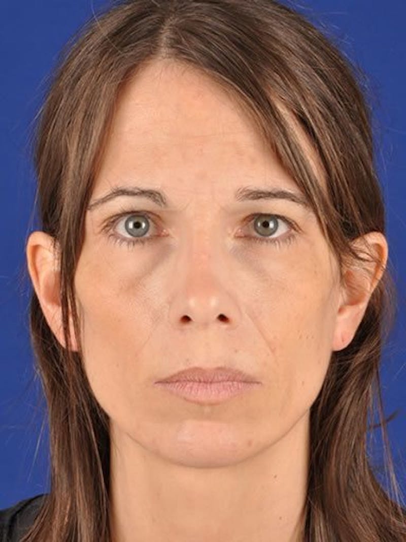 Fat Transfer Face Before & After Gallery - Patient 17363768 - Image 1