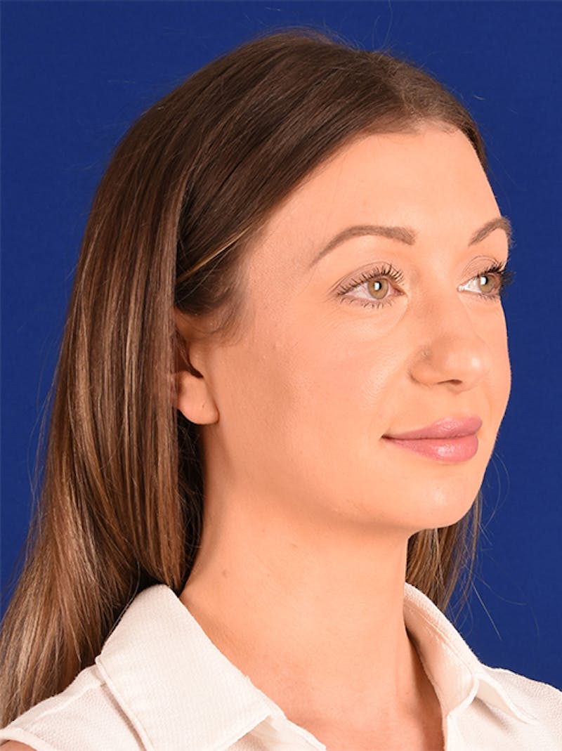 Female Rhinoplasty Before & After Gallery - Patient 17363769 - Image 3