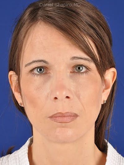 Fat Transfer Face Before & After Gallery - Patient 17363768 - Image 2