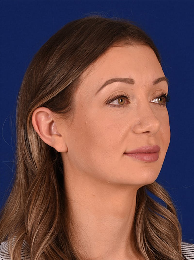 Female Rhinoplasty Before & After Gallery - Patient 17363769 - Image 4
