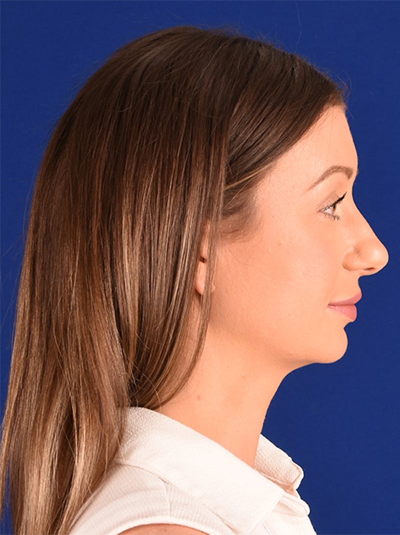 Female Rhinoplasty Before & After Gallery - Patient 17363769 - Image 5