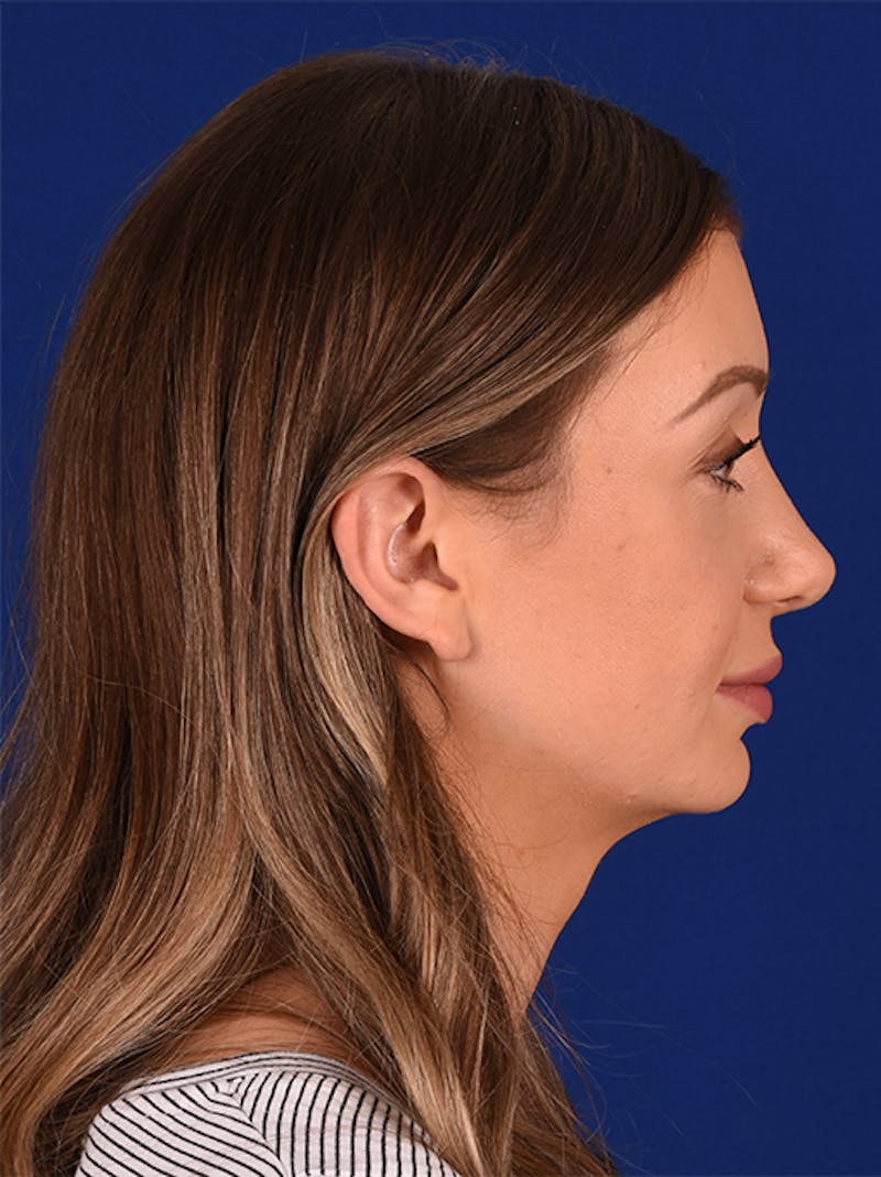 Female Rhinoplasty Before & After Gallery - Patient 17363769 - Image 6