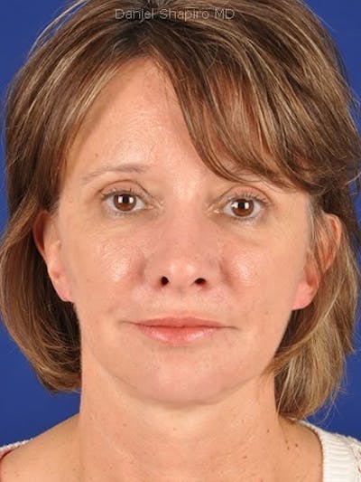 Fat Transfer Face Before & After Gallery - Patient 17363770 - Image 2