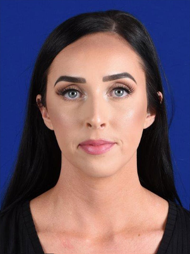 Female Rhinoplasty Before & After Gallery - Patient 17363773 - Image 1