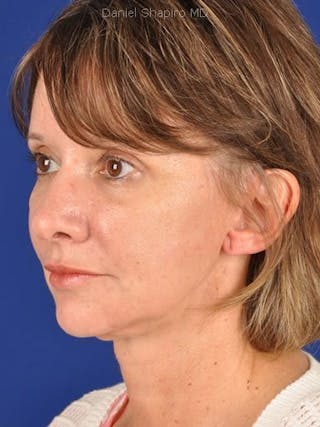 Fat Transfer Face Before & After Gallery - Patient 17363770 - Image 4