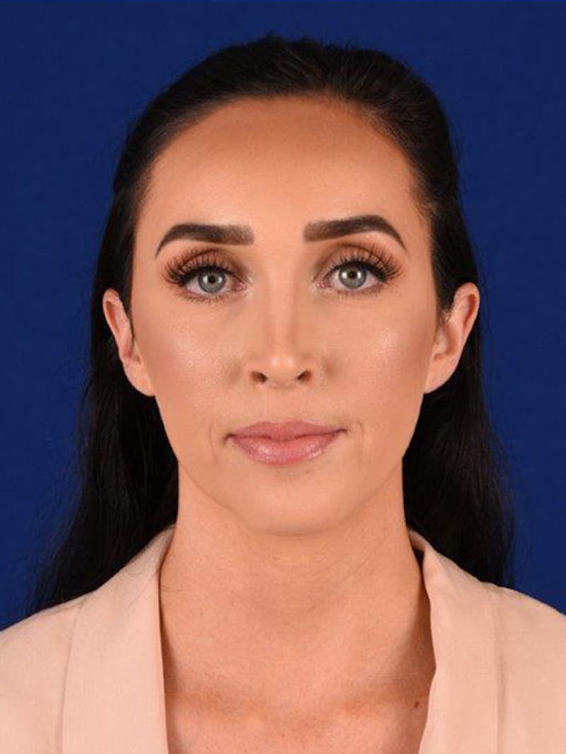 Female Rhinoplasty Before & After Gallery - Patient 17363773 - Image 2