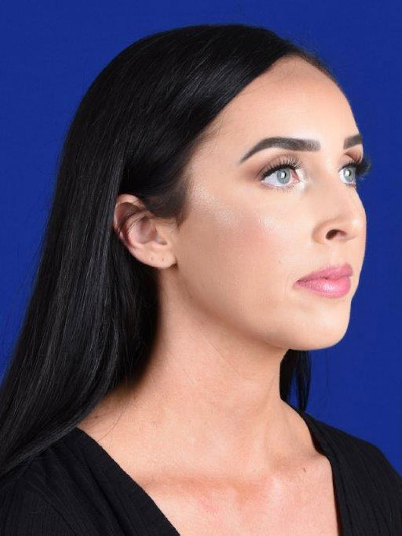 Female Rhinoplasty Before & After Gallery - Patient 17363773 - Image 3