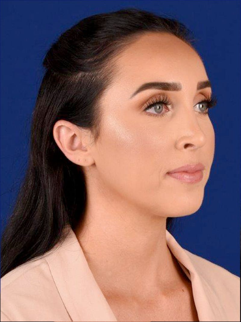 Female Rhinoplasty Before & After Gallery - Patient 17363773 - Image 4