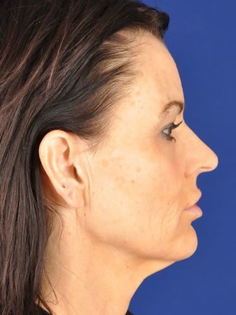 Fat Transfer Face Before & After Gallery - Patient 17363772 - Image 3