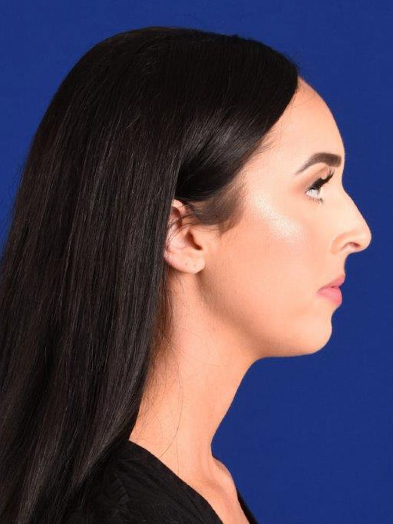 Female Rhinoplasty Before & After Gallery - Patient 17363773 - Image 5