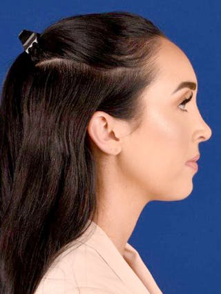 Female Rhinoplasty Before & After Gallery - Patient 17363773 - Image 6