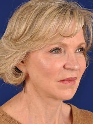 Fat Transfer Face Before & After Gallery - Patient 17363774 - Image 4