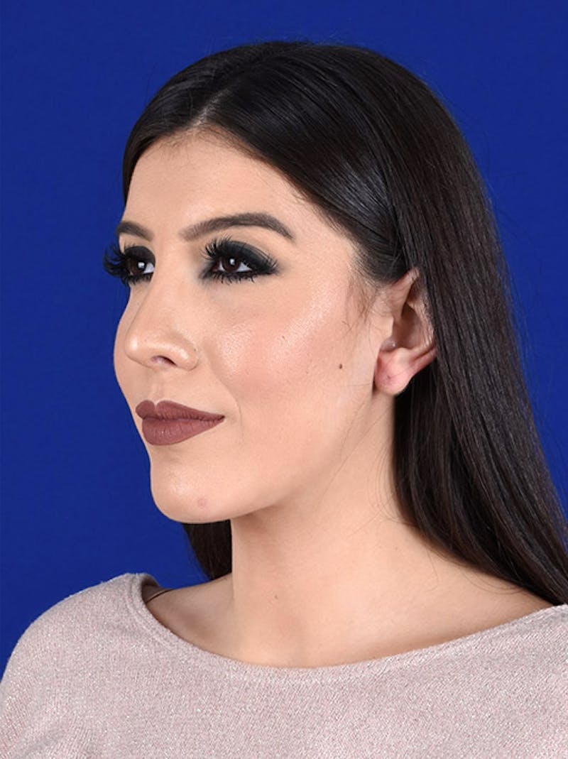 Female Rhinoplasty Before & After Gallery - Patient 17363776 - Image 4