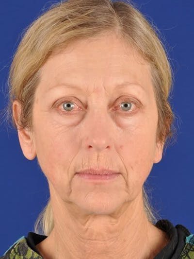 Fat Transfer Face Before & After Gallery - Patient 17363777 - Image 1