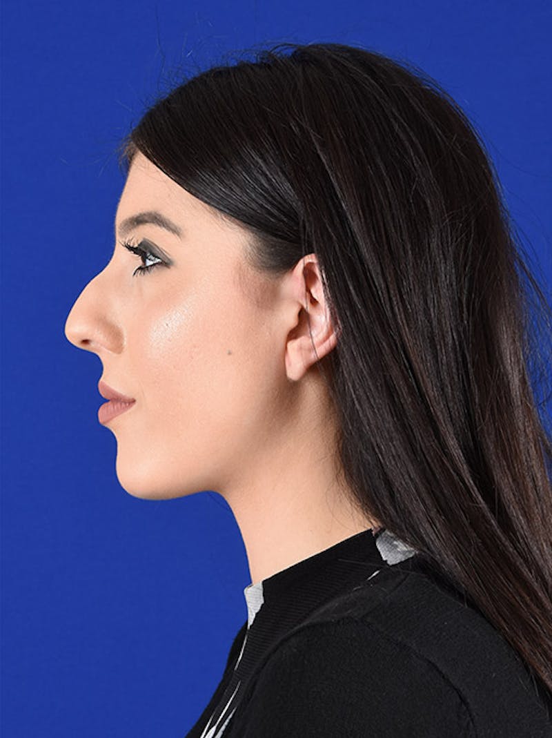 Female Rhinoplasty Before & After Gallery - Patient 17363776 - Image 5