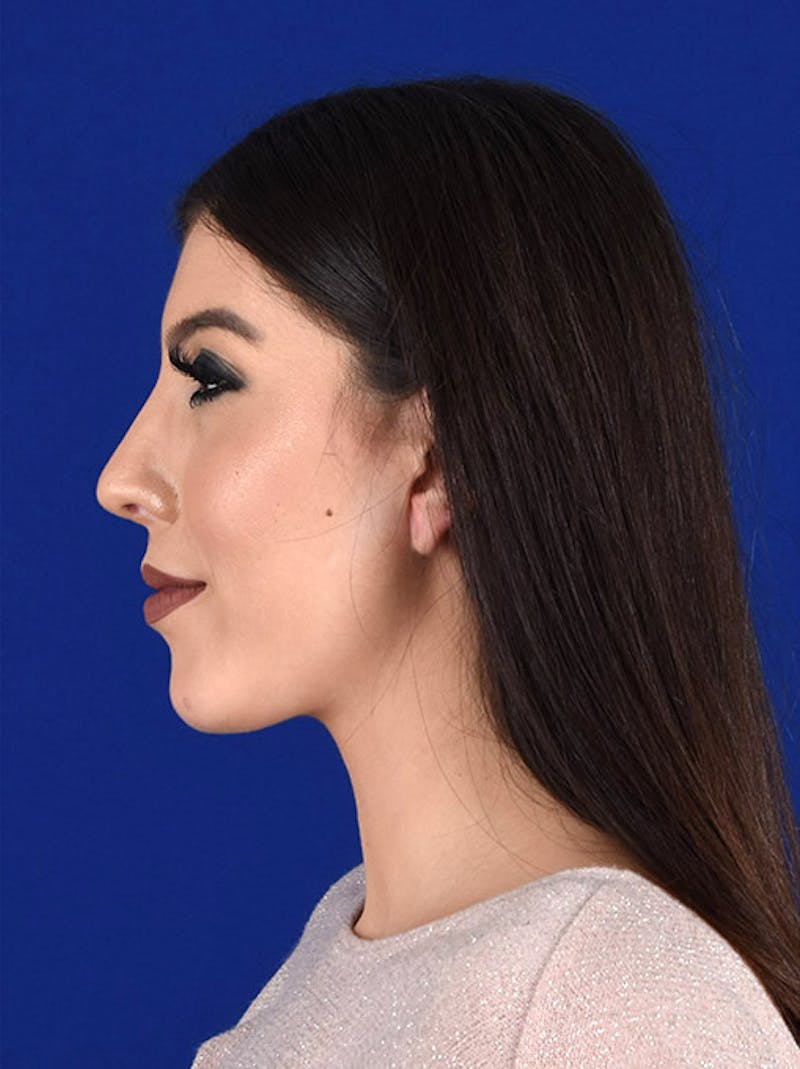 Female Rhinoplasty Before & After Gallery - Patient 17363776 - Image 6