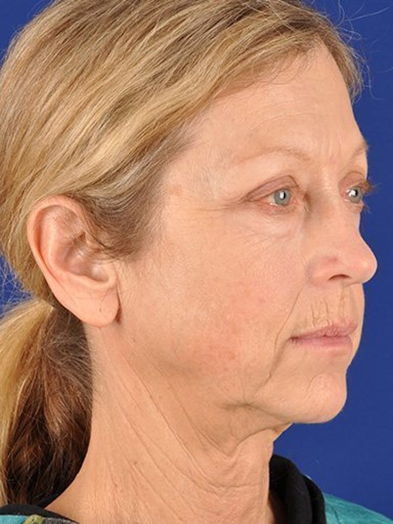 Fat Transfer Face Before & After Gallery - Patient 17363777 - Image 3