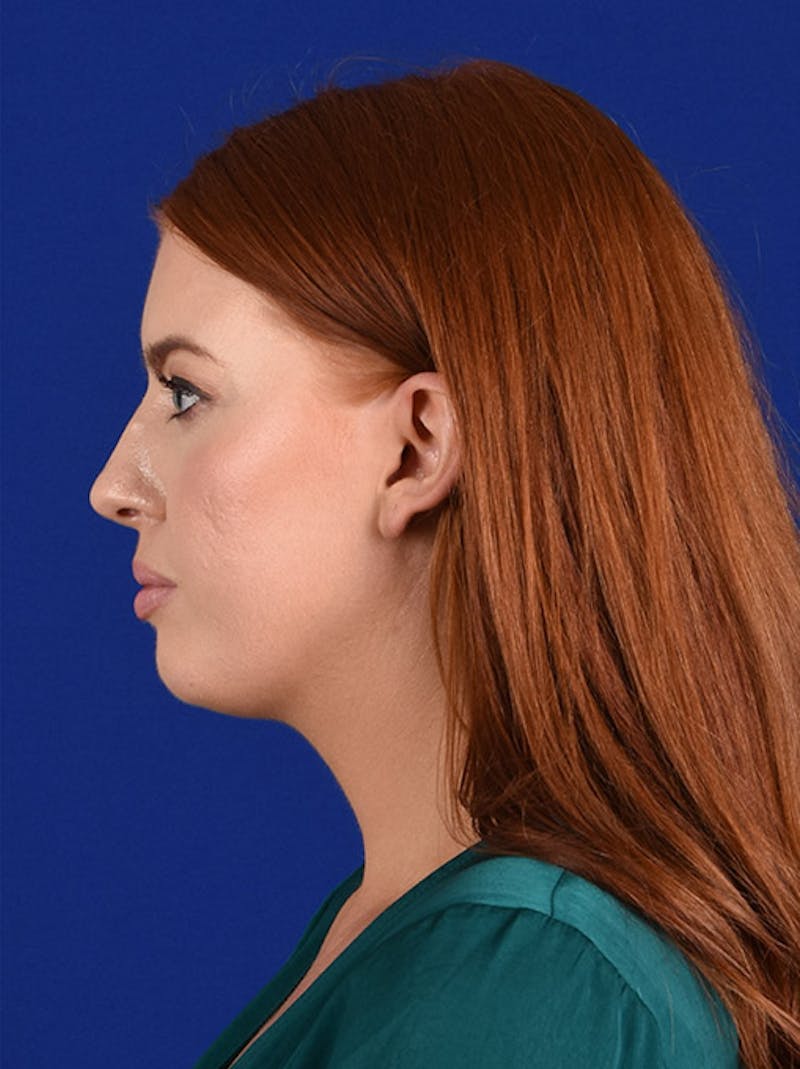 Female Rhinoplasty Before & After Gallery - Patient 17363779 - Image 5