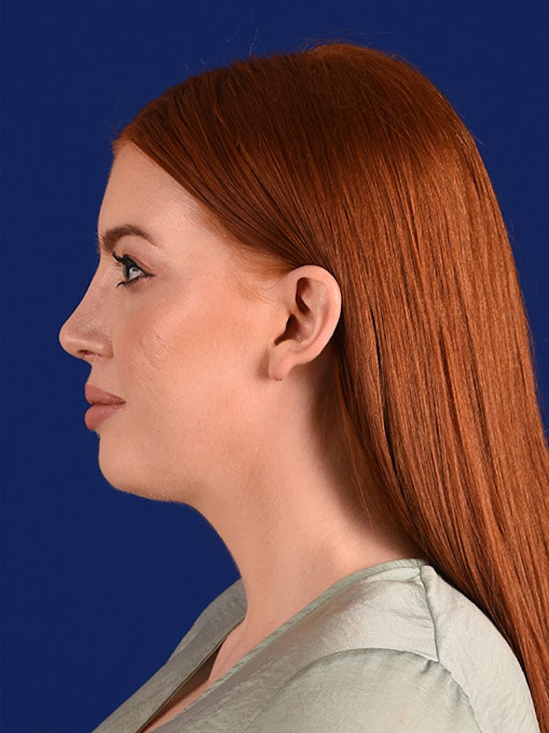 Female Rhinoplasty Before & After Gallery - Patient 17363779 - Image 6