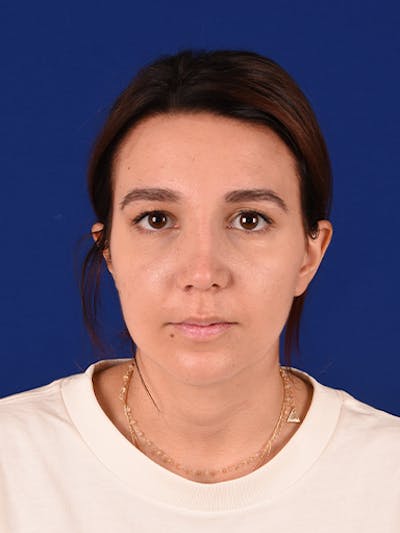 Female Rhinoplasty Before & After Gallery - Patient 17363781 - Image 2