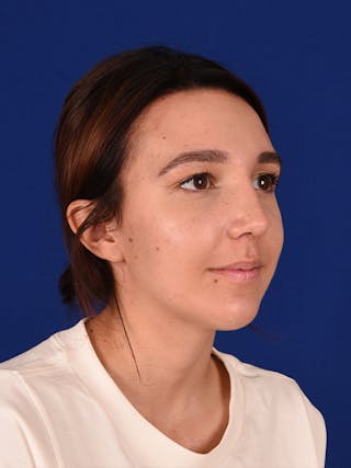 Female Rhinoplasty Before & After Gallery - Patient 17363781 - Image 4