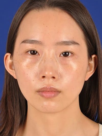 Fat Transfer Face Before & After Gallery - Patient 17363782 - Image 1